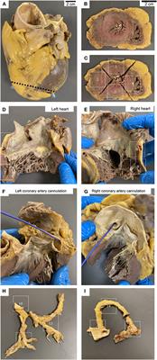 Late Cardiac Pathology in Severe Covid-19. A Postmortem Series of 30 Patients